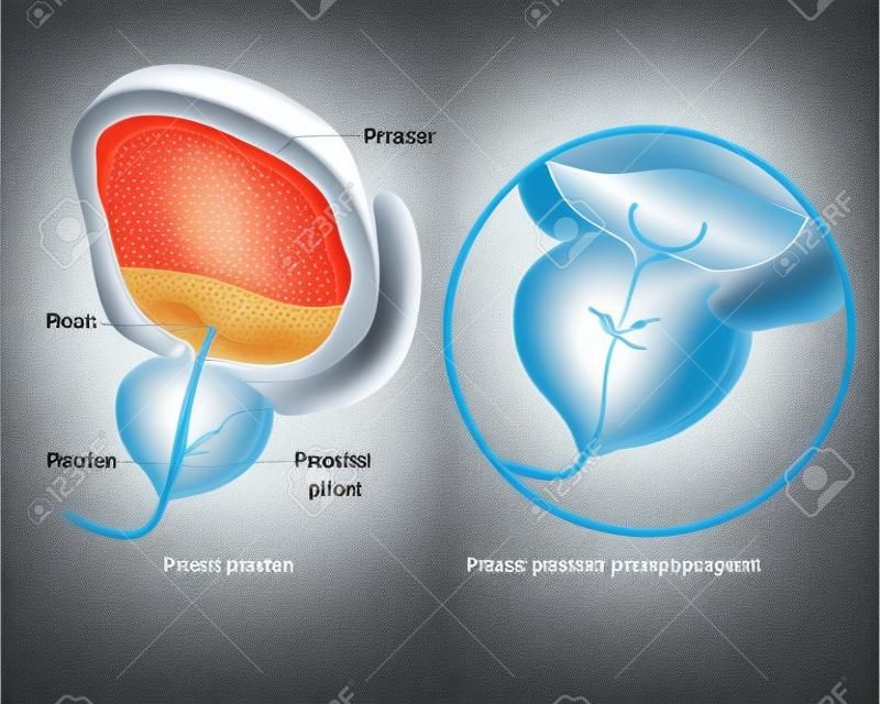 Ilustracja wektora medycznego przedstawiająca łagodny rozrost gruczołu krokowego BPH i normalną prostatę. powiększenie gruczołu krokowego