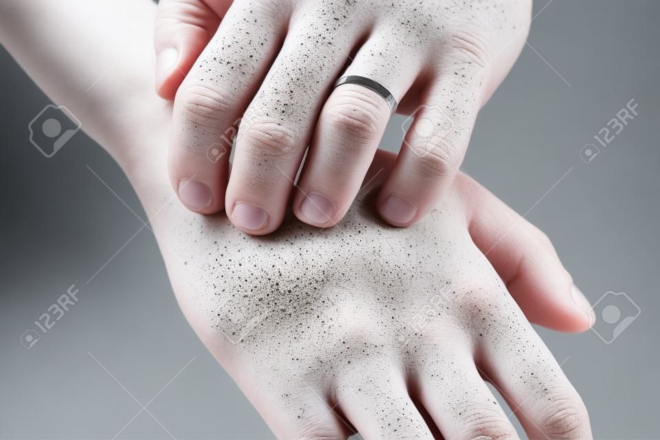 L'uomo si gratta, si asciuga la pelle secca con la psoriasi volgare, l'eczema e altre condizioni della pelle come funghi, placca, rash e cerotti. Malattia genetica autoimmune