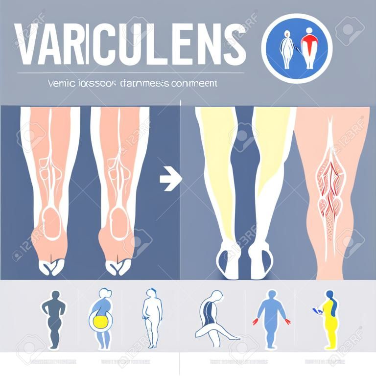 Doenças vasculares. Sintomas de varizes, conjunto de ícones de tratamento. Design de infográfico médico. Ilustração vetorial