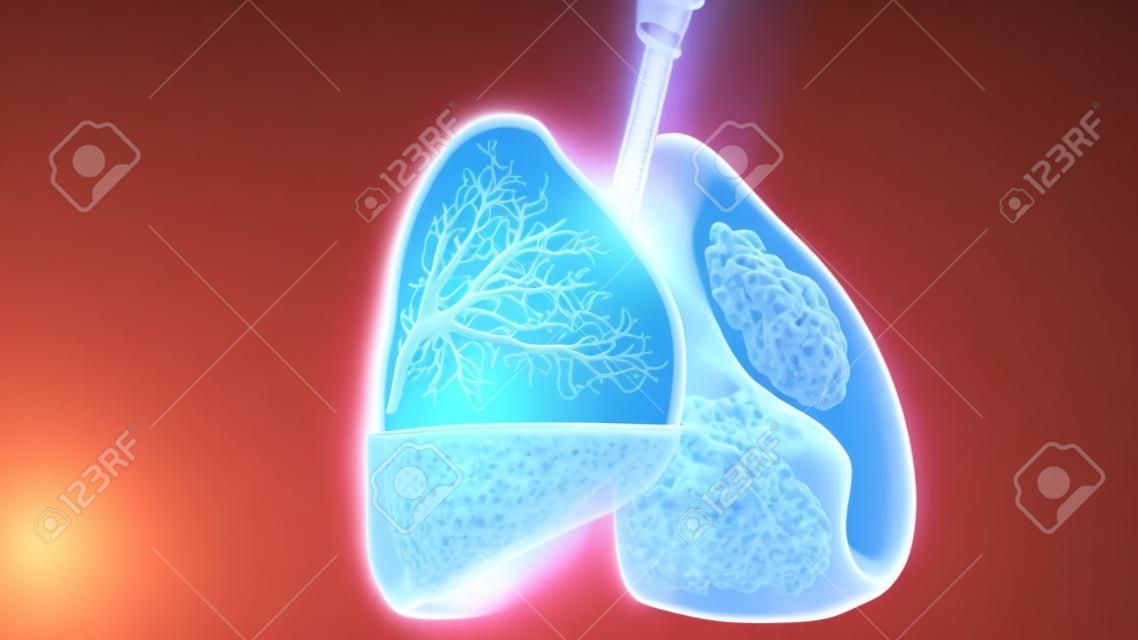3d Illustration of Hemopneumothorax, Normal lung versus collapsed, symptoms of Hemopneumothorax, pleural effusion, empyema, complications after a chest injury, air in the pleural space, 3d Render
