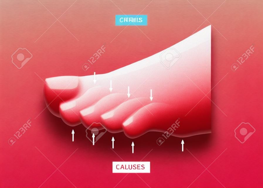 Illustration of difference between Corns and calluses. Used: gradient, transparency