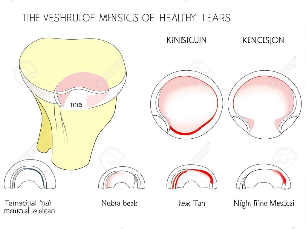 ベクターの図。健康なヒト膝関節における半月板の解剖学。メニシの断面を有する末梢メニスカル涙。広告、医療出版物のため。EPS 10.