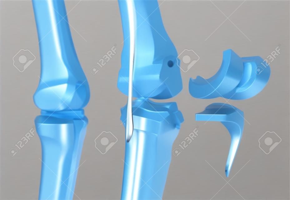 Joint cerniera del ginocchio e titanio. Isolated on white
