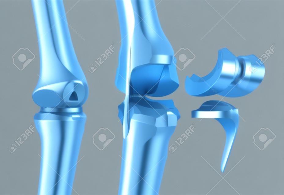 Joint cerniera del ginocchio e titanio. Isolated on white