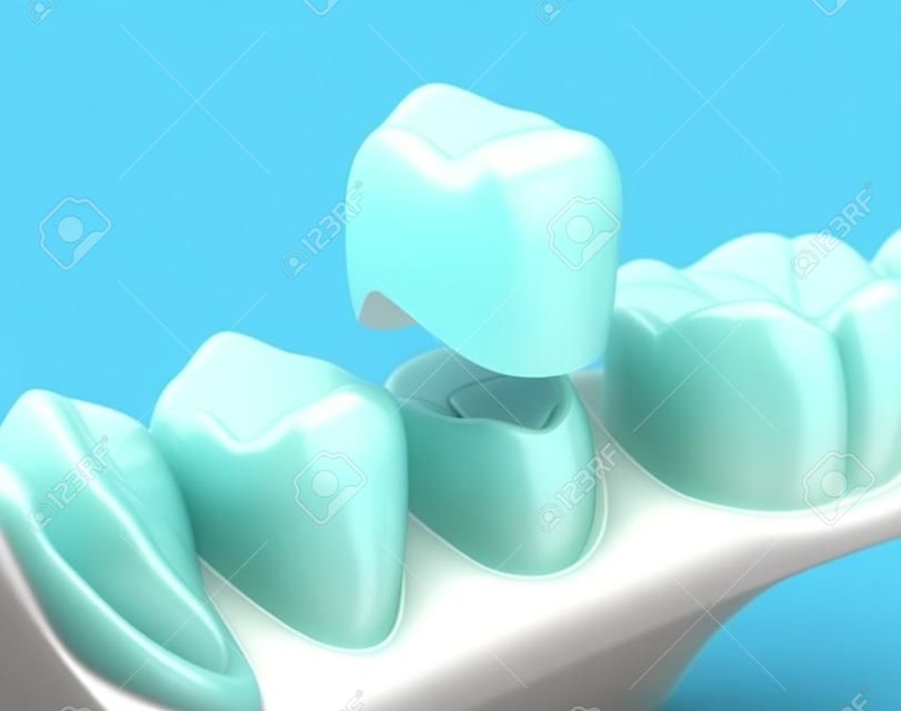 Zahnkronen-Prämolarenzahnmontageprozess. Medizinisch genaue 3D-Darstellung der menschlichen Zahnbehandlung