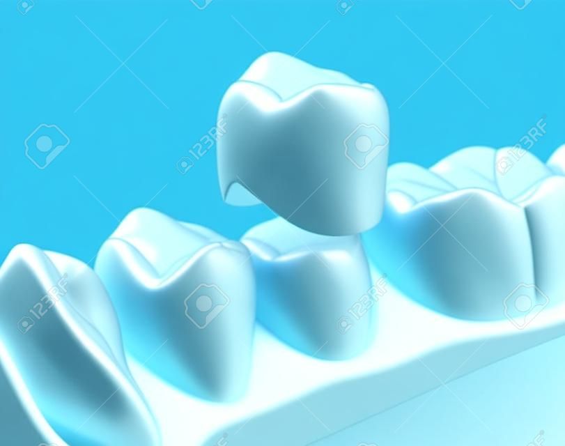 치과 크라운 소구치 조립 과정. 인간의 치아 치료의 의학적으로 정확한 3D 그림