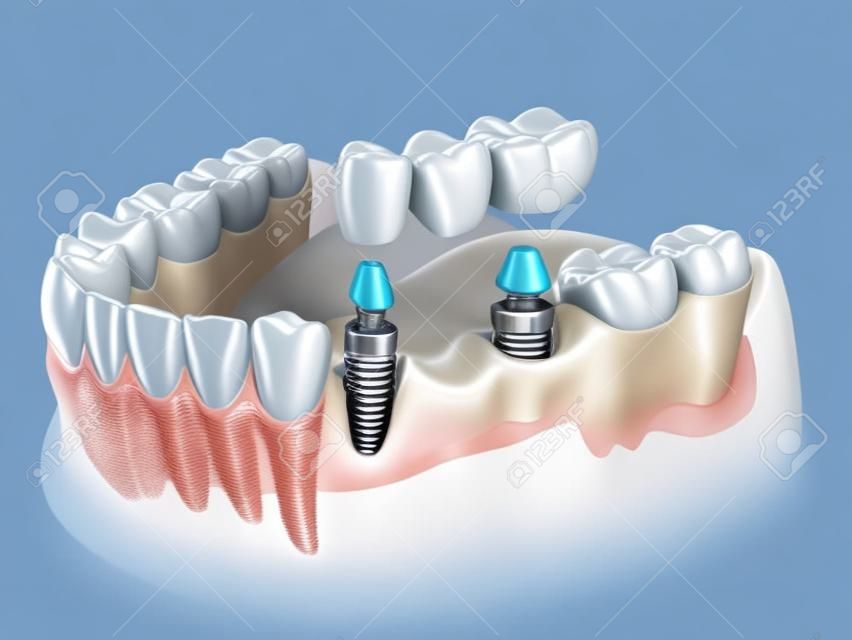 Von Implantaten getragene Zahnbrücke. Medizinisch genaue 3D-Darstellung von menschlichen Zähnen und Zahnersatz