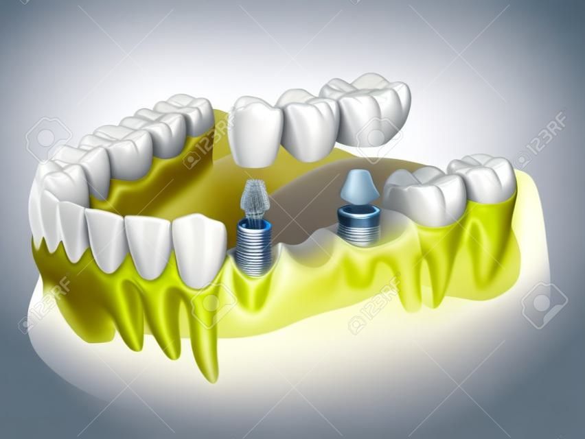 Von Implantaten getragene Zahnbrücke. Medizinisch genaue 3D-Darstellung von menschlichen Zähnen und Zahnersatz