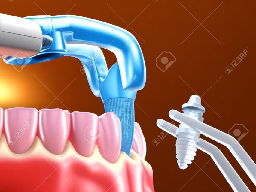 Extraktion und Implantation, komplexe Sofortchirurgie. Medizinisch genaue 3D-Darstellung der Zahnbehandlung