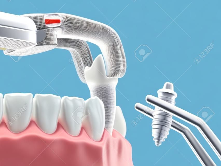 추출 및 이식, 복잡한 즉시 수술. 치과 치료의 의학적으로 정확한 3d 일러스트