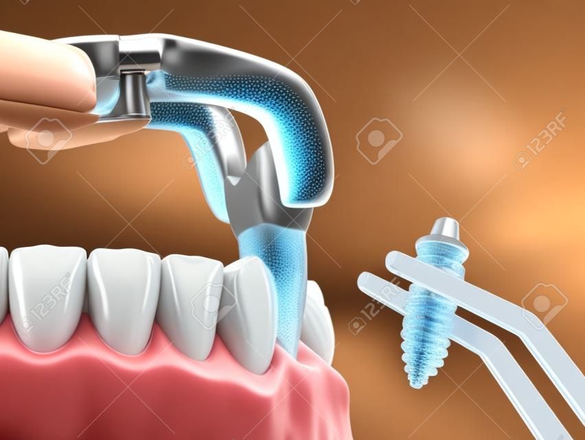 Extraction et Implantation, chirurgie immédiate complexe. Illustration 3D médicalement précise d'un traitement dentaire