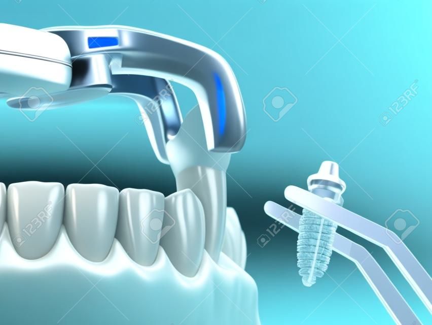 Extraktion und Implantation, komplexe Sofortchirurgie. Medizinisch genaue 3D-Darstellung der Zahnbehandlung