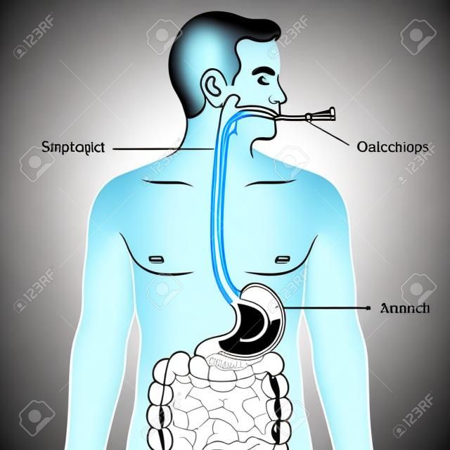 Schemat intubacji nosowo-żołądkowej, schematyczna ilustracja wektorowa, ilustracja edukacyjna nauk medycznych