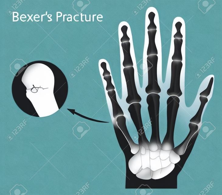 Boxer fracture, eps8