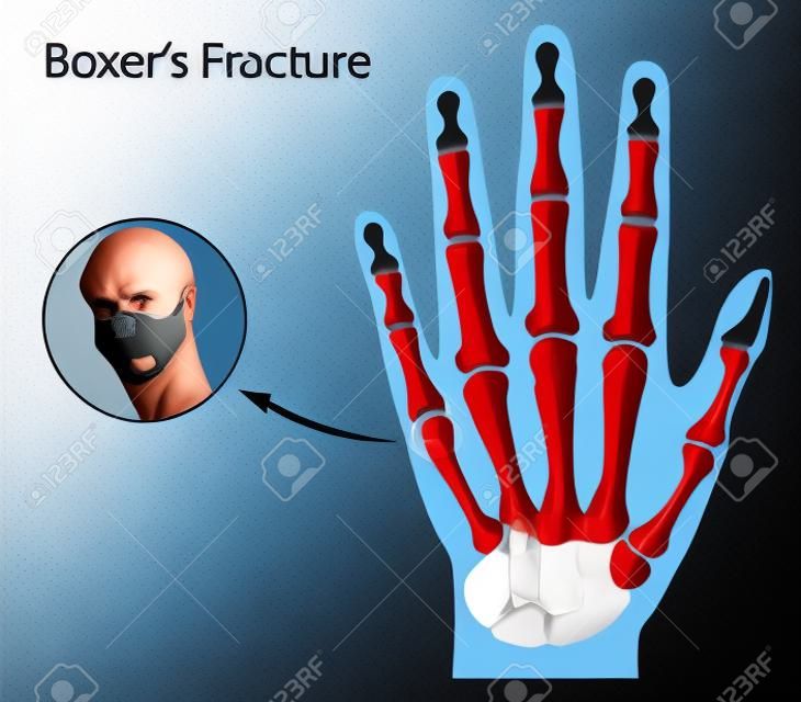 Boxer fracture, eps8