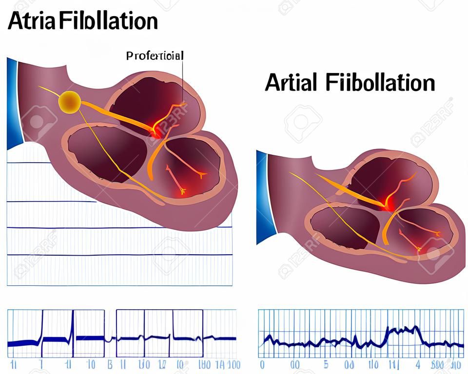 Atrial fibrillation 