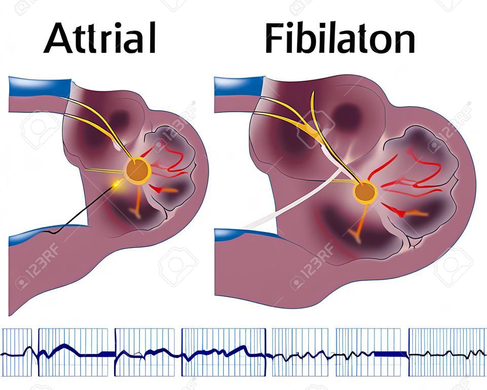 Atrial fibrillation 