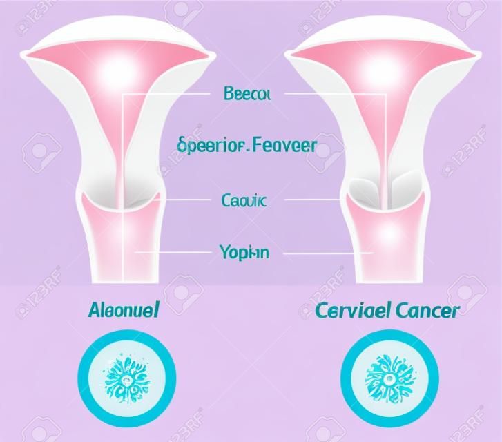 El cáncer cervical