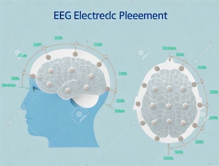 EEG elektróda elhelyezés