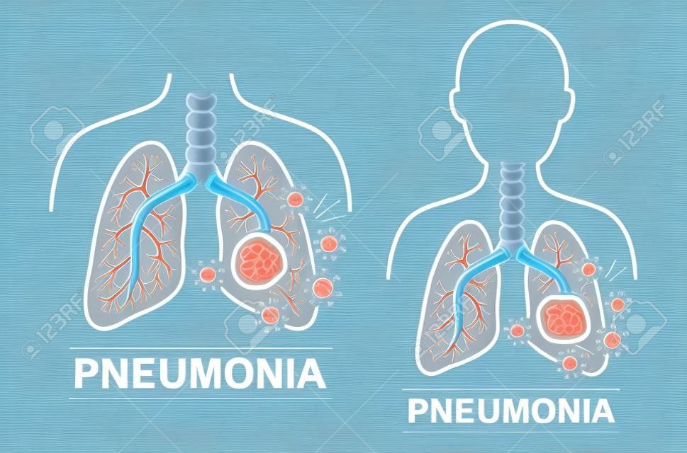 Pneumonie ziekte pictogram set. Menselijke longen en luchtpijp anatomie. Behandeling voor longontsteking. Behandeling voor coronavirus of bacteriële aanval van de luchtwegen. Platte vector voor medicijnen verpakking ontwerp