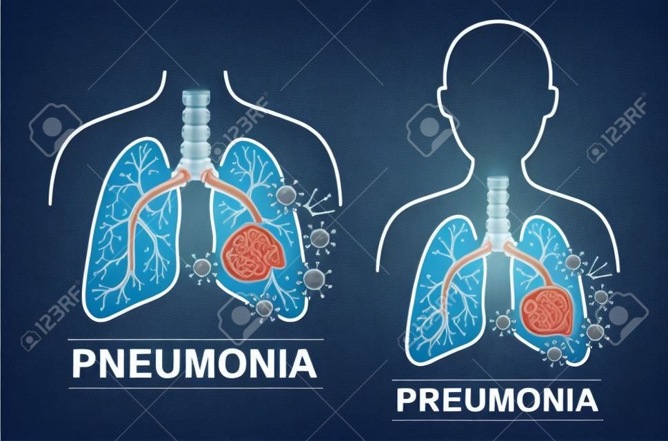 Pneumonie ziekte pictogram set. Menselijke longen en luchtpijp anatomie. Behandeling voor longontsteking. Behandeling voor coronavirus of bacteriële aanval van de luchtwegen. Platte vector voor medicijnen verpakking ontwerp