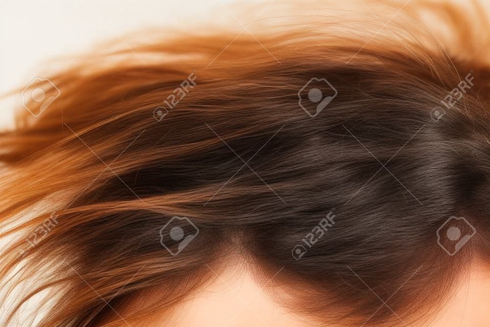 Hautkrankheiten, auf der Kopfhaut, Frau mit Schuppen im dunklen Haar