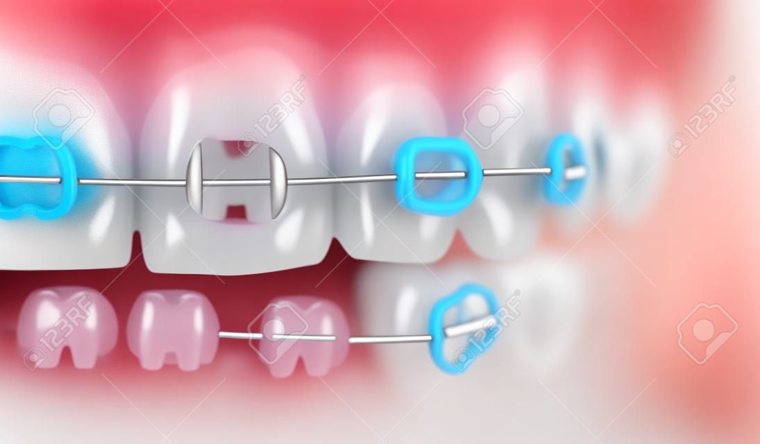 Macro snapshot of dental occlusion, teeth and ceramic braces with colorful rubber bands on them. Concept of dental hygiene, dentistry and orthodontic treatment.