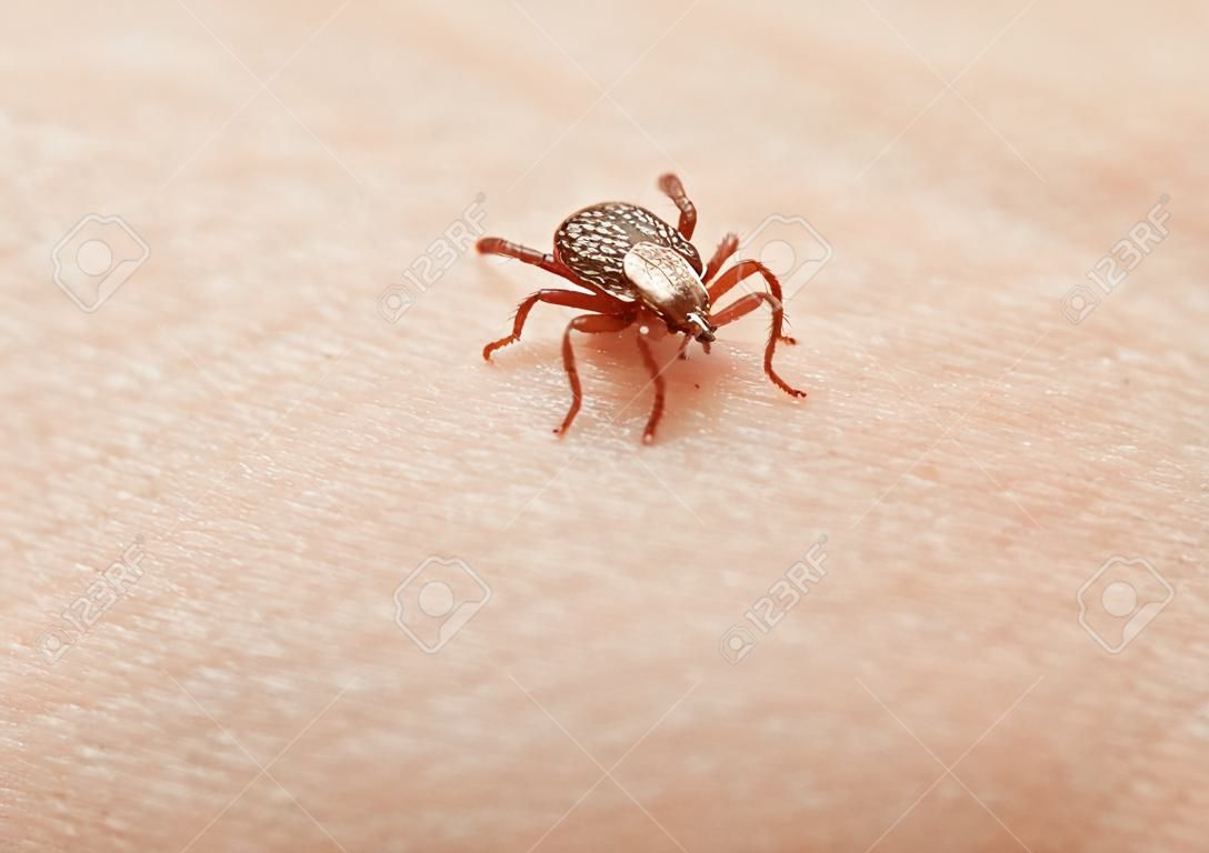 Macro of bloodsucker vermin tick (Dermacentor variabilis) crawling on human skin