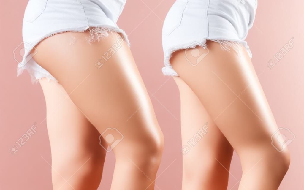 여성 다리와 허벅지의 비교 셀 룰 라이트없이. 피부 문제, 바디 케어, 과체중 및 다이어트 개념.