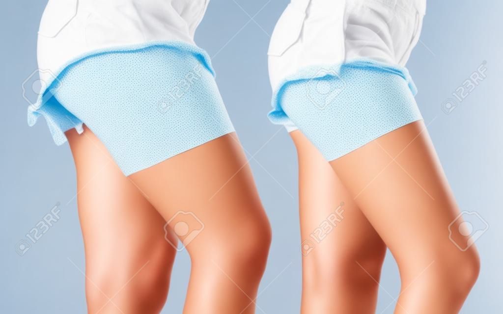 Porównanie ud kobiecych nóg z cellulitem i bez. Problem ze skórą, pielęgnacja ciała, nadwaga i koncepcja diety.