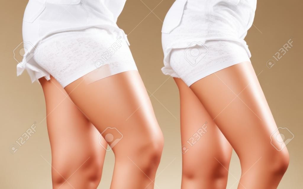 여성 다리와 허벅지의 비교 셀 룰 라이트없이. 피부 문제, 바디 케어, 과체중 및 다이어트 개념.
