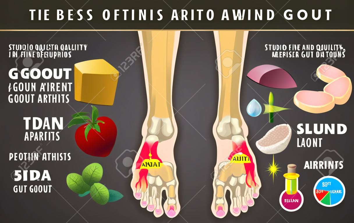 infográfico de artrite de gota