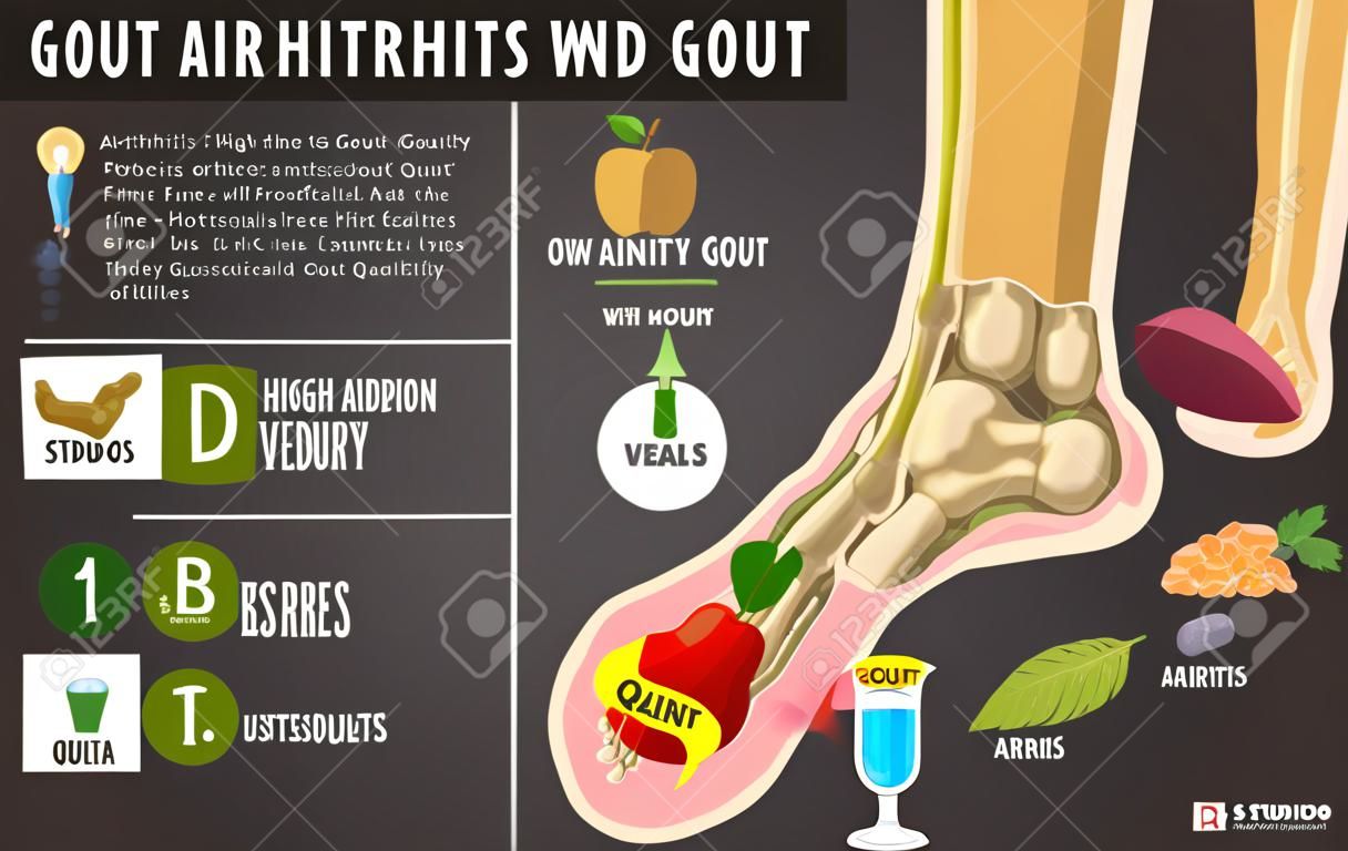 Infografika artretyzmu dny moczanowej