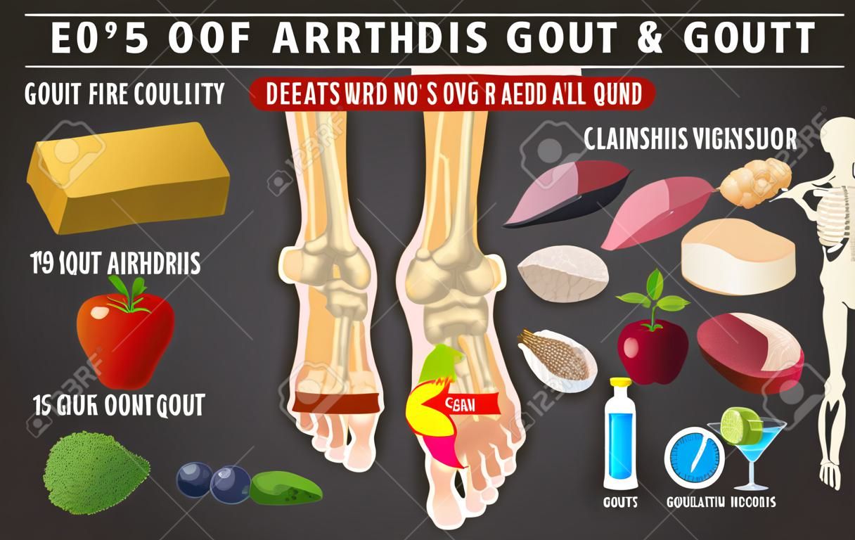 Infographie sur l'arthrite de la goutte