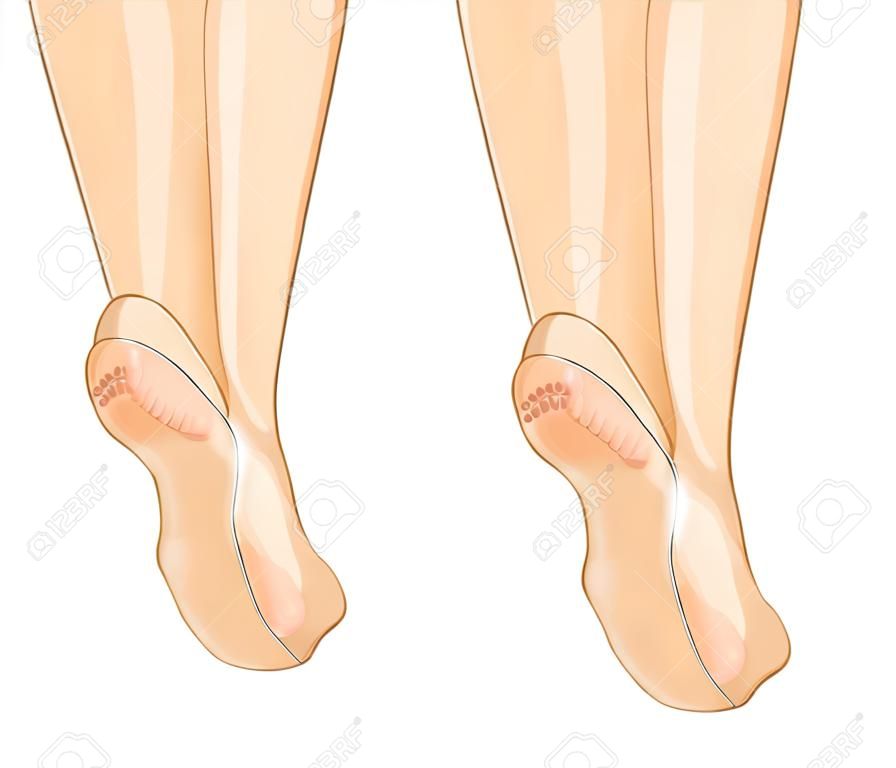illustration of a female feet, cracked heels and healthy