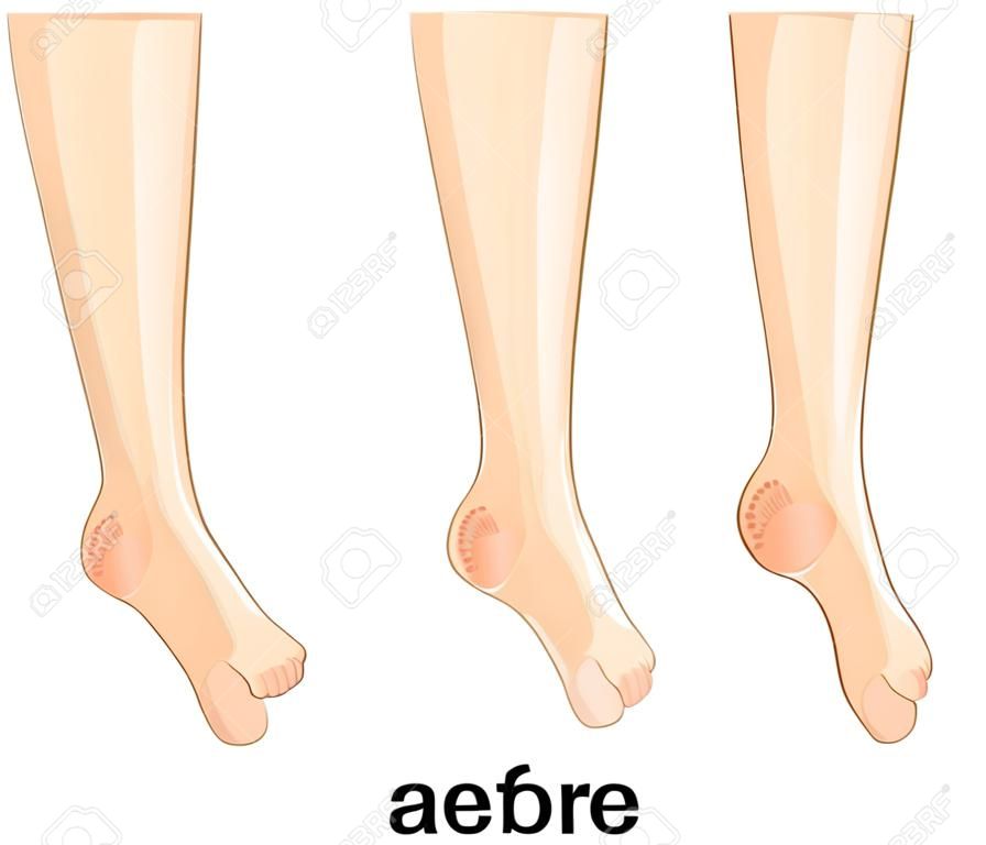 Illustration eines weiblichen Füße, rissige Fersen und gesund