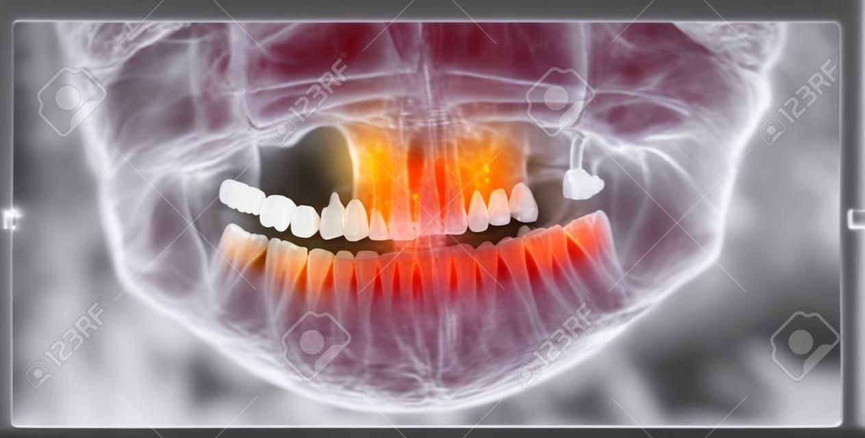 Panoramique X-Ray Image de dents