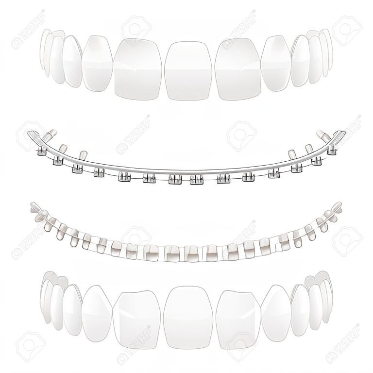 Breuken op witte tanden en na genezing orthodontische tandheelkunde medische behandeling set realistische vector