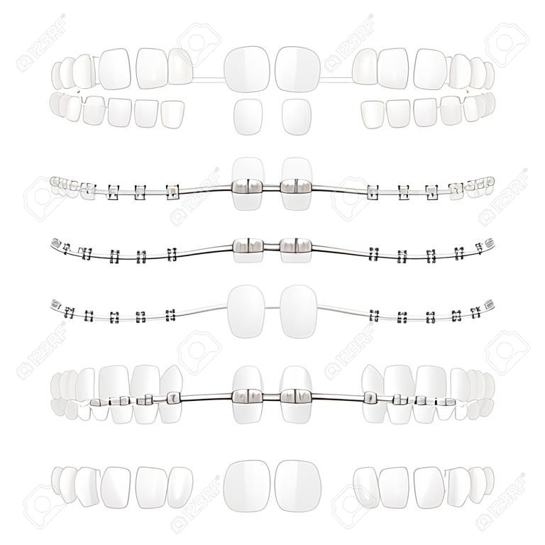 Breuken op witte tanden en na genezing orthodontische tandheelkunde medische behandeling set realistische vector