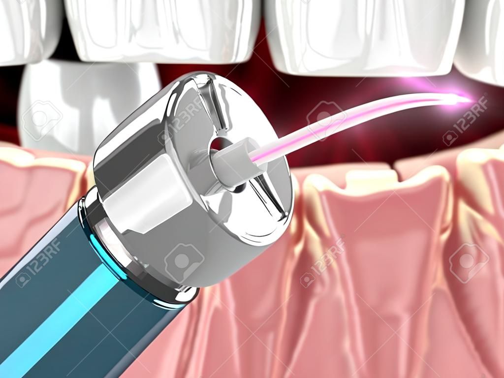 Rendering 3d del laser a diodi dentali utilizzato per il trattamento delle gengive. Il concetto di utilizzare la terapia laser nel trattamento delle gengive