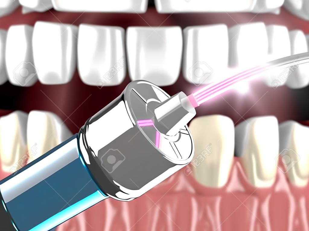 歯茎の治療に使用される歯科ダイオードレーザーの3Dレンダリング。歯茎の治療にレーザー療法を用いるという概念