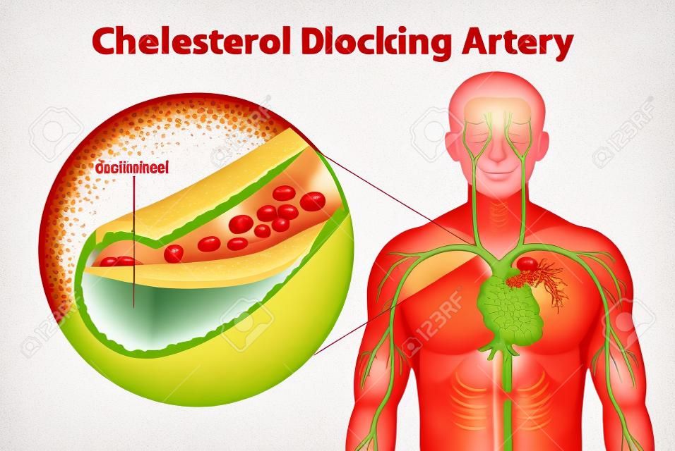 Ilustración que muestra el proceso de ateriosclerosis
