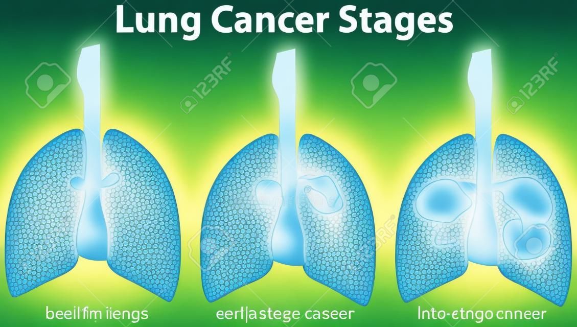 Afbeelding toont longkanker stadia illustratie