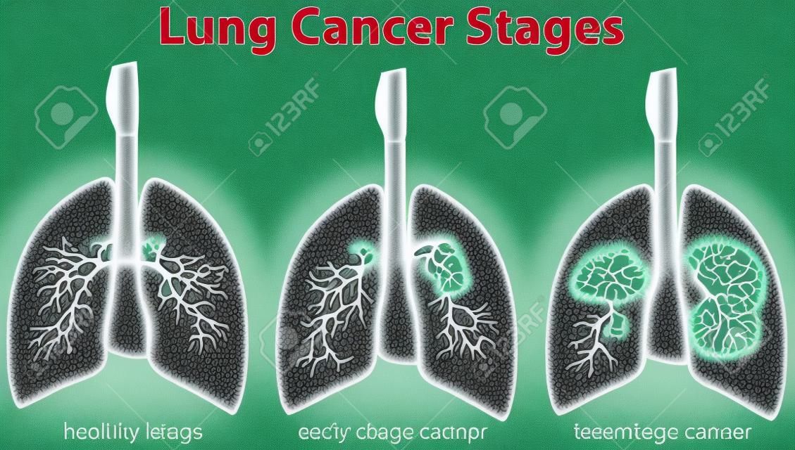 Schemat przedstawiający ilustrację etapów raka płuc