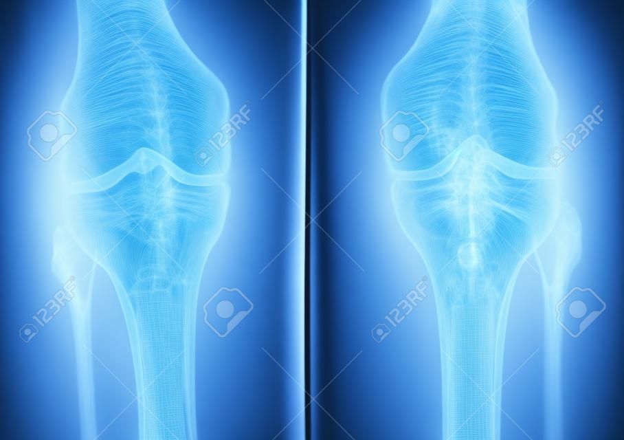 x-ray film of knee