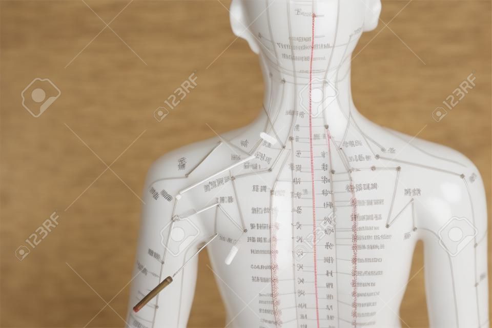modelo femenino de la acupuntura con agujas en el hombro