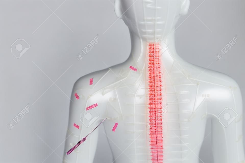 Agopuntura modello femminile con aghi della spalla