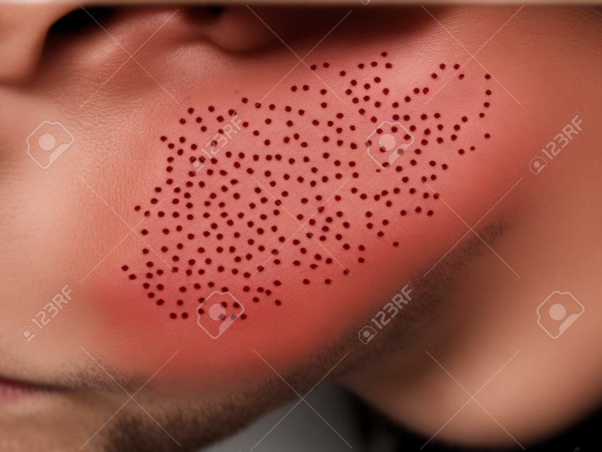 Schimmel huiduitslag infectie mark. Close up zicht van de pleister die donkerder is dan de gezonde omliggende huid.