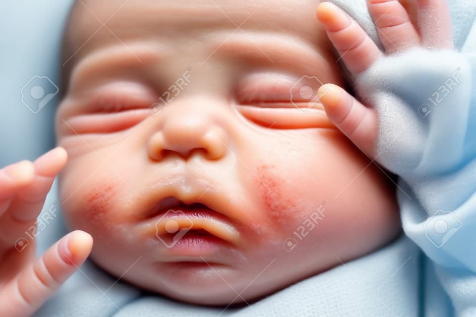 Primo piano del volto di un neonato con brufoli sulle guance a causa dell'accumulo di cheratina. acne neonatale, milia, ingrasso. irritazione e accumulo di brufoli sull'infa