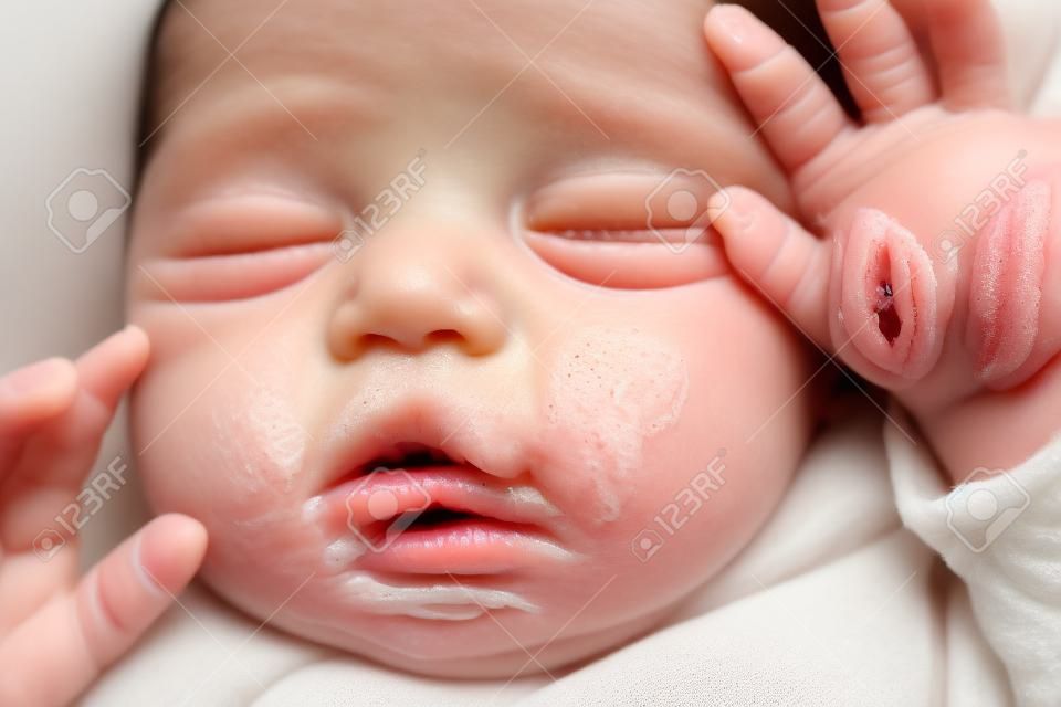 ケラチンの蓄積による頬ににきびがある新生児の顔の接写。新生児にきび、ミリア、肥育。インファのにきびの刺激と蓄積